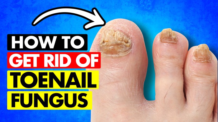 Diy foot fungus treatment