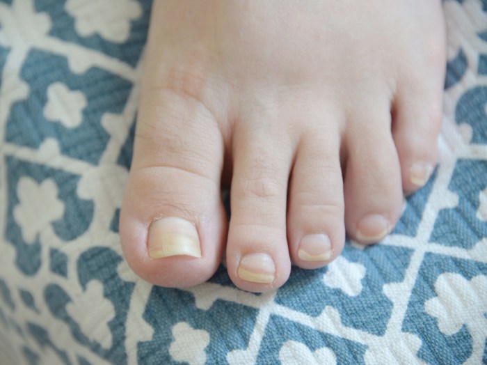 Diy foot fungus treatment